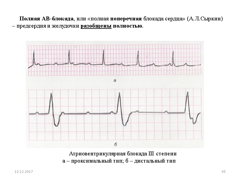 13.12.2017 35      Атриовентрикулярная блокада III степени а – проксимальный